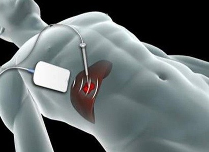 Interventional procedure in progress